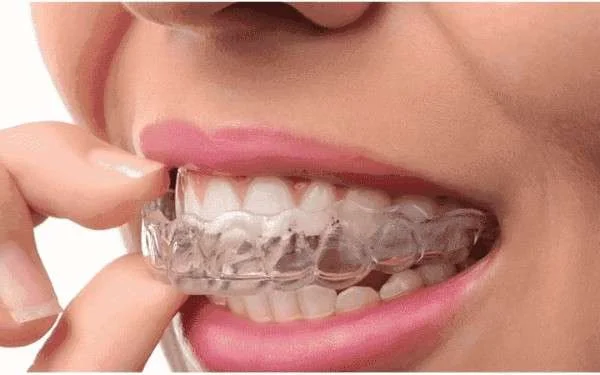 Invisible Braces