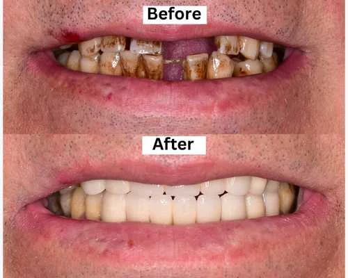 Full Mouth Rehabilitation Kavithas Dental Enclave Tirupur