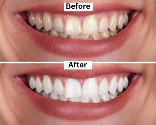 Teeth Whiteining   Kavithas Dental Enclave Tirupur 