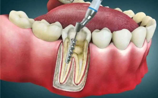 Root Canal Treatment