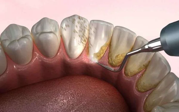 Preventive Dentistry