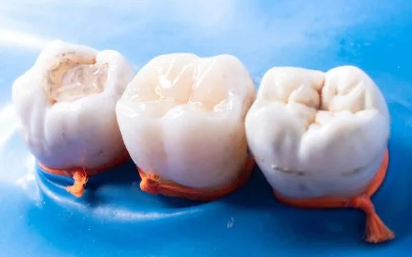 Tooth Fillings in Tirupur