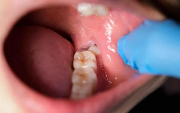 Wisdom Tooth Removal